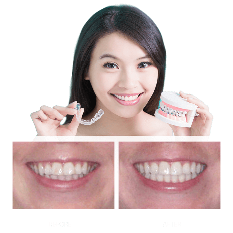 Invisalign Treatment: the Best Way to Get a Smile You Love